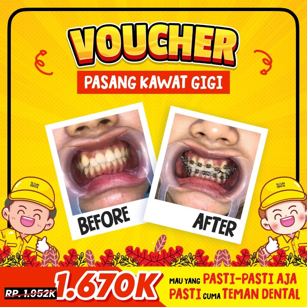Promo Kawat Gigi Teman Dental